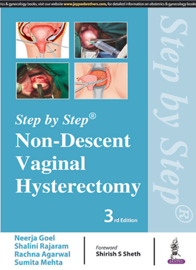 Step by Step Non-Descent Vaginal Hysterectomy