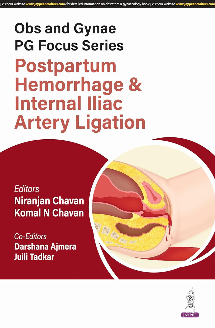 Obs and Gynae Pg Focus Series Postpartum Hemorrhage & Internal Iliac Artery Ligation