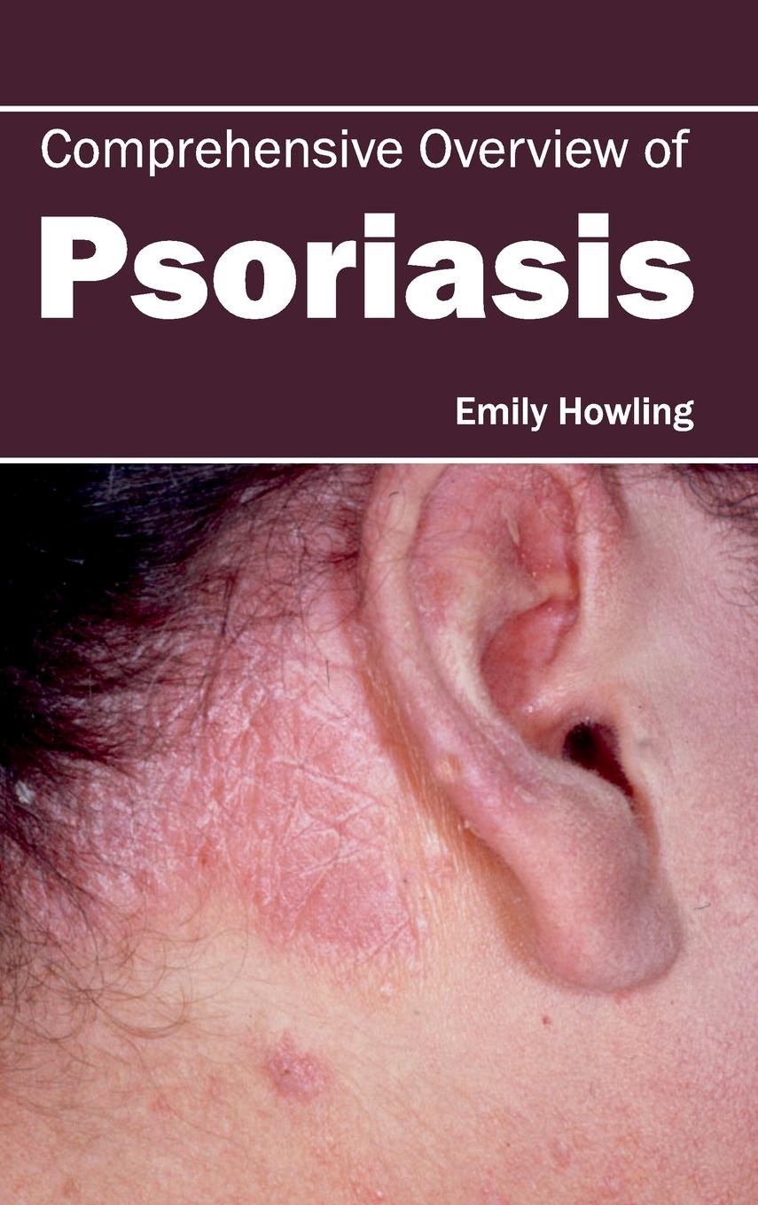 Comprehensive Overview Of Psoriasis : 1/E 2015