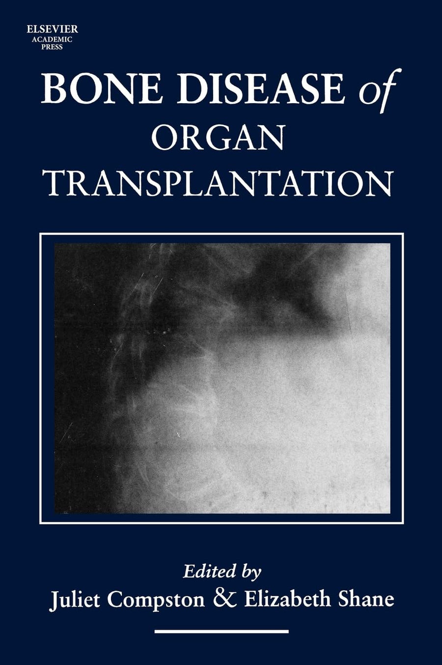 Bone Disease Of Organ Transplantation