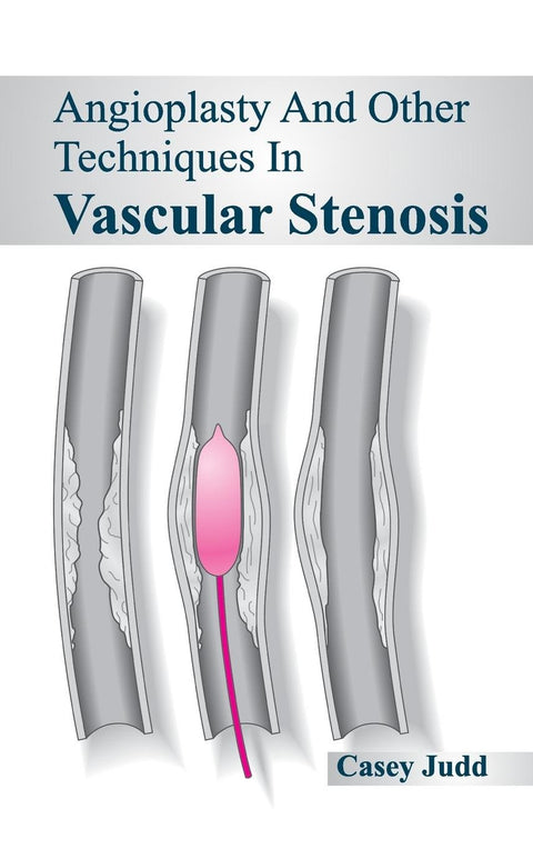 Angioplasty And Other Techniques In Vascular Stenosis : 1/E 2015