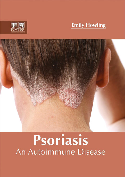 Psoriasis: An Autoimmune Disease; 1/E 2017