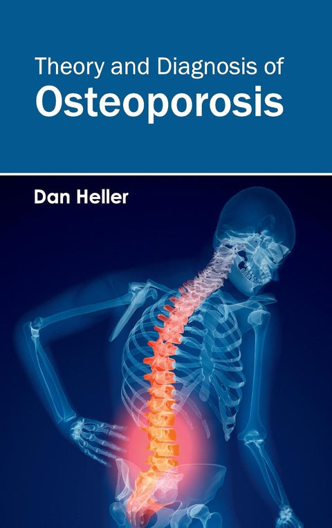 Theory And Diagnosis Of Osteoporosis : 1/E 2015